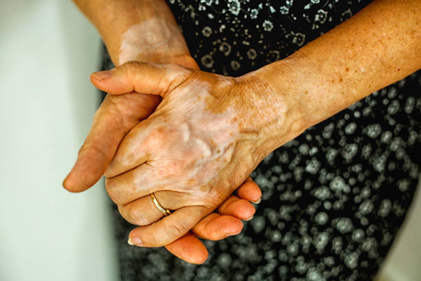 Experienced autoimmune disease? Tackle With EFT Meridian Technique