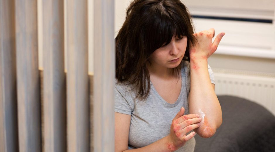 EFT Tapping for Psoriasis: A Holistic Approach to Wellness