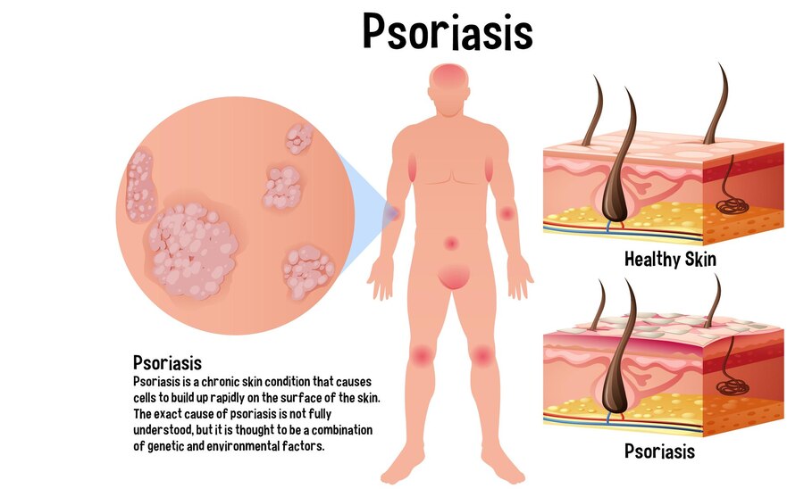 What is psoriasis; EFT Tapping for psoriasis